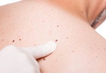 Naravno nad bradavice